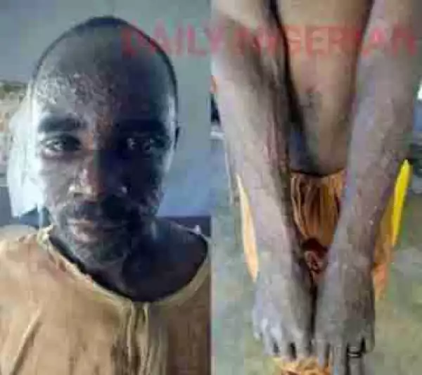 Panic as Monkey Pox Patient Flees from Hospital in Kano State (Photo)